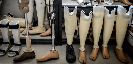 В июле в ДНР будут бесплатно протезированы более 30 человек, - соцстрах республики