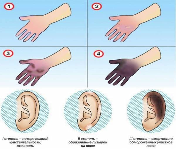 ПЕРВАЯ ПОМОЩЬ ПРИ ОБМОРОЖЕНИИ
