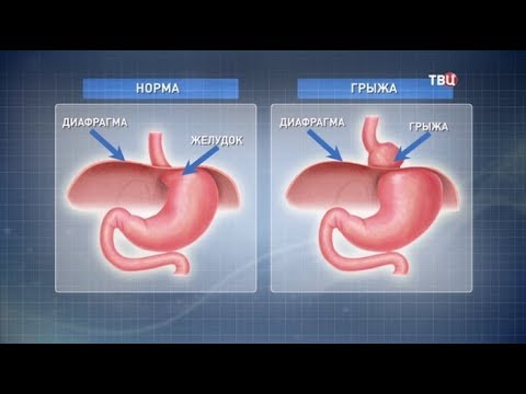 Грыжа пищевода. Доктор И... (Видео)